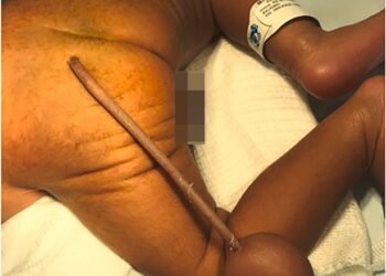 KEADAAN bayi yang dilahirkan dengan ekor serta ‘bebola daging’ di hospital di Fortaleza, Brazil. - AGENSI