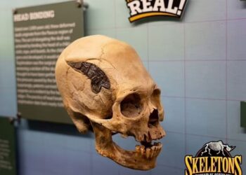 TENGKORAK dipercayai milik pahlawan Peru yang menjalani pembedahan mencantumkan kepingan logam bagi membaiki struktur yang patah. - MUZIUM OSTEOLOGI