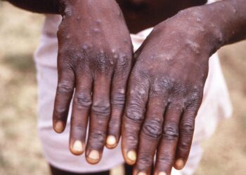 KEADAAN tapak tangan pesakit yang menghidap penyakit mpox.- AGENSI