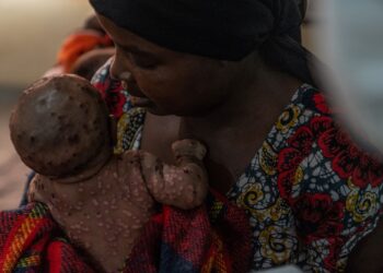 SEORANG wanita mendukung bayinya yang menderita wabak Mpox di hospital Kavumu di timur Republik Demokratik Congo.-AFP