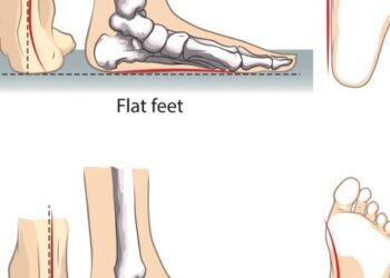 PERBEZAAN lengkungan antara tapak kaki normal dengan tapak kaki rata.