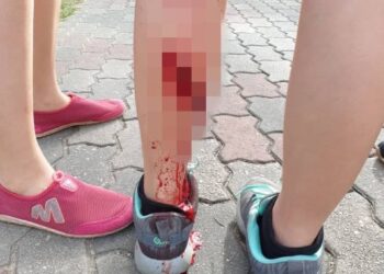 KECEDERAAN yang dialami seorang wanita akibat diserang seekor beruk ketika sedang berjoging di Taman Tasik Taiping, Taiping, Sabtu lalu. - MEDIA SOSIAL