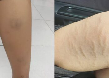 KESAN lebam dan kecederaan pada kaki dua orang pelajar tingkatan dua sebuah sekolah berasrama penuh di Labu, Seremban yang didakwa dipukul dengan penyangkut baju dan kayu penyapu oleh pelajar senior.